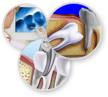pingree-dental-tooth-removal